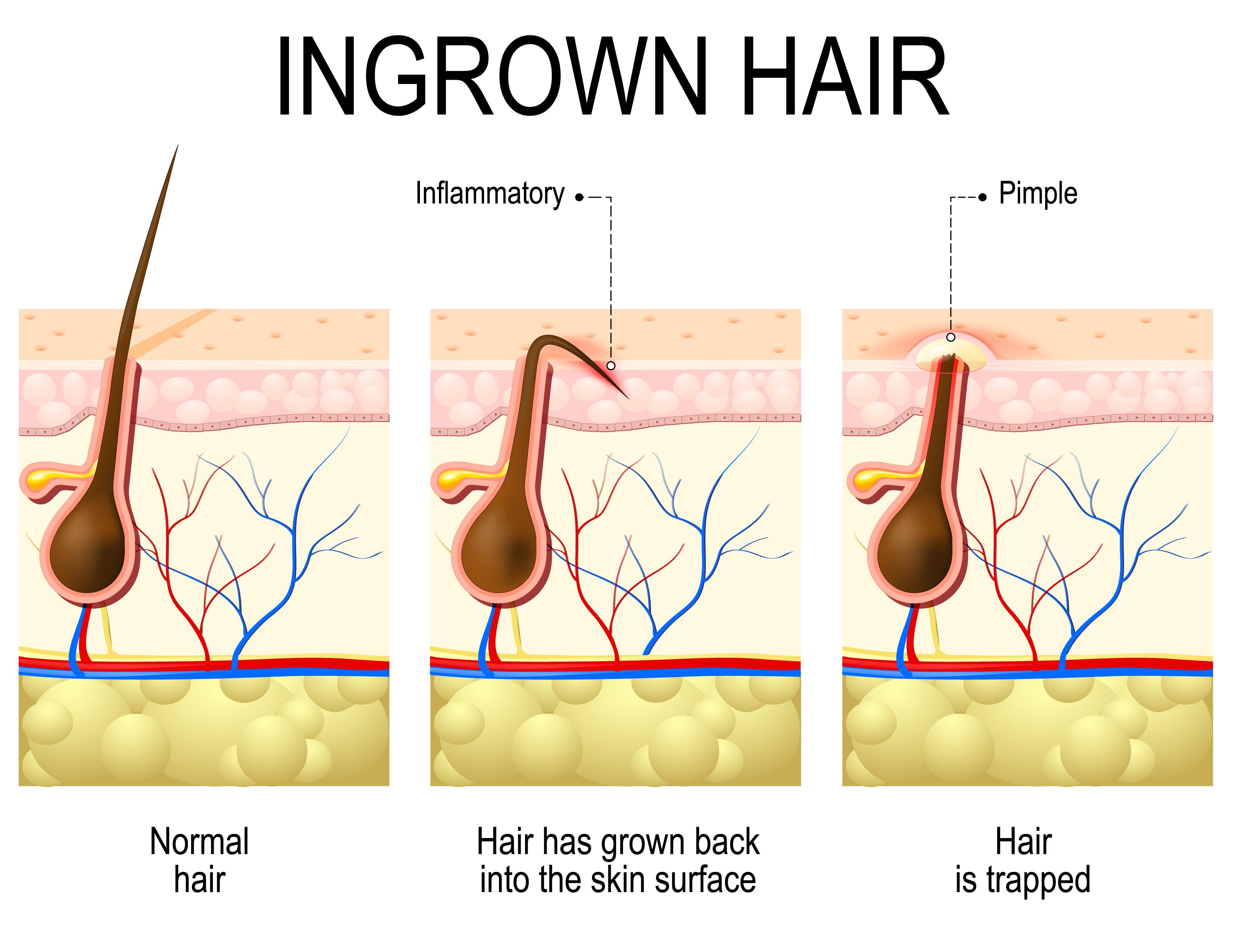 Defeating Ingrown Hairs: Prevention Strategies ​That⁣ Work