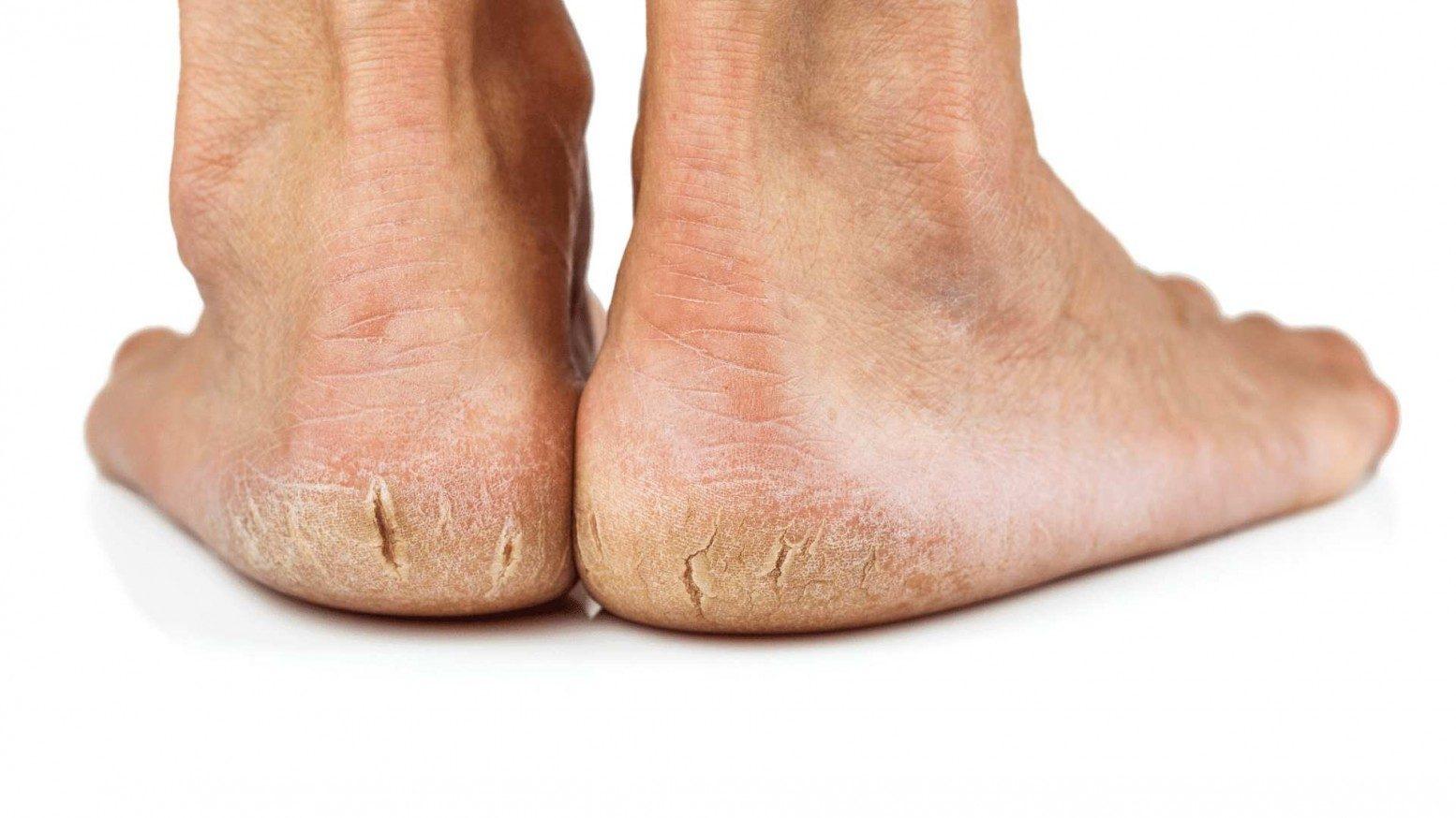 Understanding the Causes of Dry, Cracked Heels